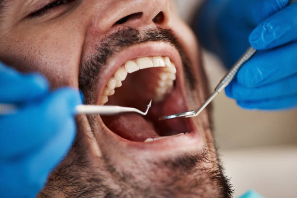 Best Emergency Tooth Extraction in Hawthorne, FL